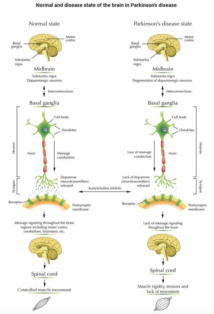 Normal and disease state of the brain in Parkinson's Disease